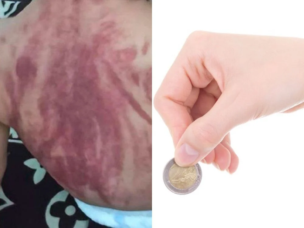 Bayi di TikTok Dikerok Hingga Gosong, Dokter Anak UM Surabaya Berikan Tanggapan