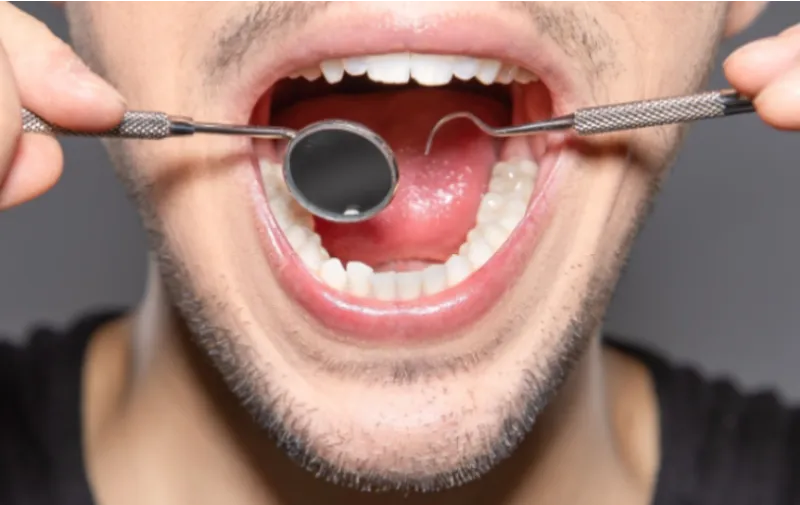 Dokter UMY Kenalkan Metode SAMURI: Cara Mudah Deteksi Kanker Mulut dari Rumah