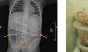 Anak di Jember Alami Perut Membesar karena Cacing, Ini Kata Ahli Parasitologi UM Surabaya