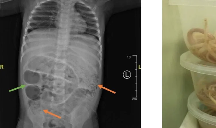 Anak di Jember Alami Perut Membesar karena Cacing, Ini Kata Ahli Parasitologi UM Surabaya