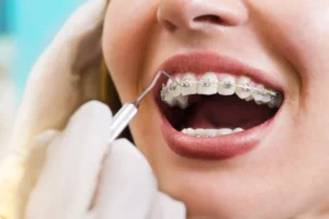 5 Tips Merawat Gigi Behel agar Tetap Sehat