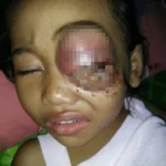 Terkena Tumor Mata, Farah Anak Keluarga Miskin Ini Butuh Bantuan Pengobatan