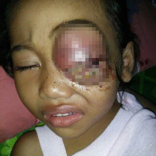 Terkena Tumor Mata, Farah Anak Keluarga Miskin Ini Butuh Bantuan Pengobatan